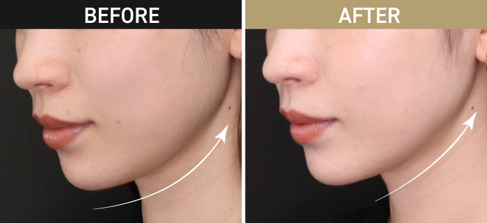 ボルニューマの施術説明