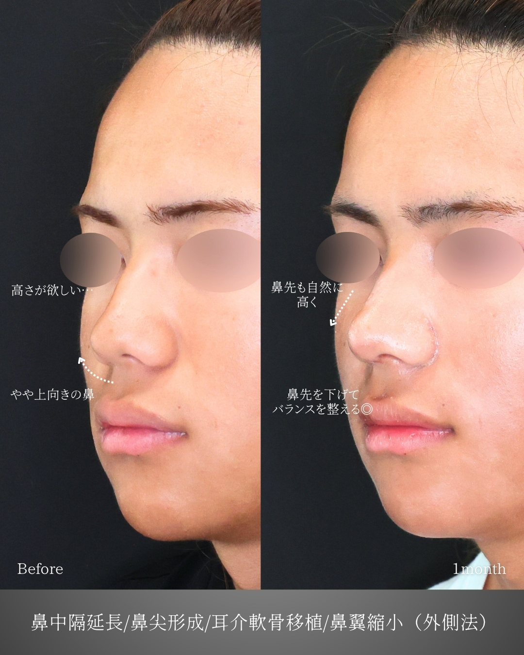 鼻中隔延長術/鼻尖形成・鼻尖縮小/TAC式 鼻翼縮小術（小鼻縮小）の症例写真 施術前後 