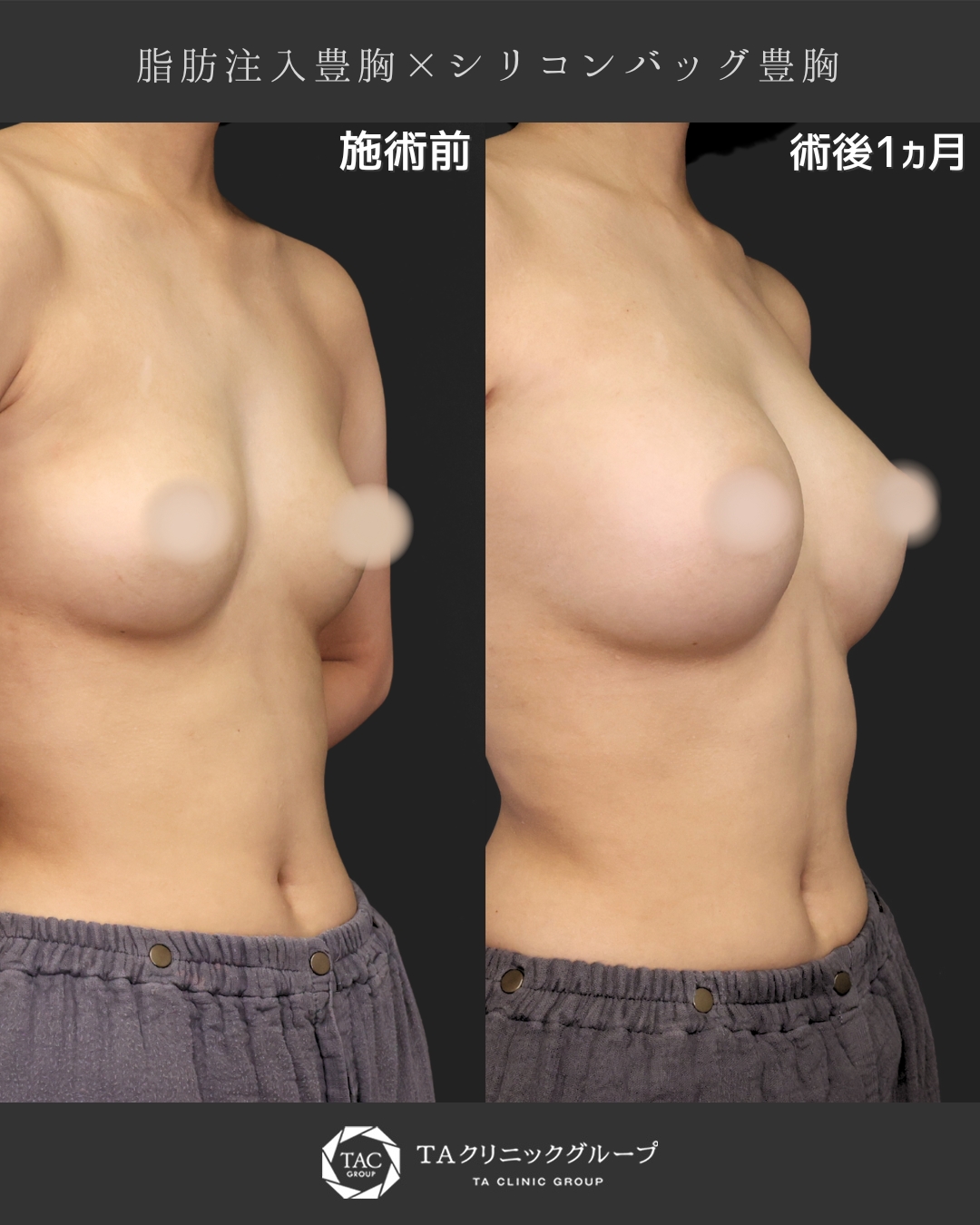 【ハイブリッド豊胸】“自然な仕上がり”を叶えた1ヶ月後の症例｜脂肪注入×シリコンバッグ