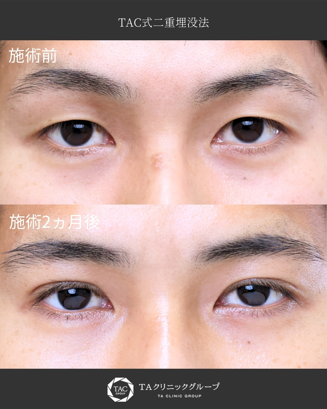 【メンズ二重埋没】長年お悩みだった一重を二重に！