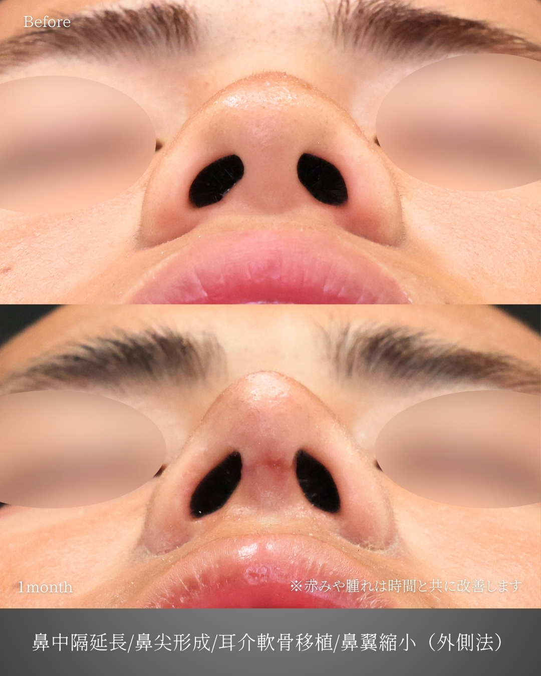 鼻中隔延長術/鼻尖形成・鼻尖縮小/TAC式 鼻翼縮小術（小鼻縮小）の症例写真 施術前後 