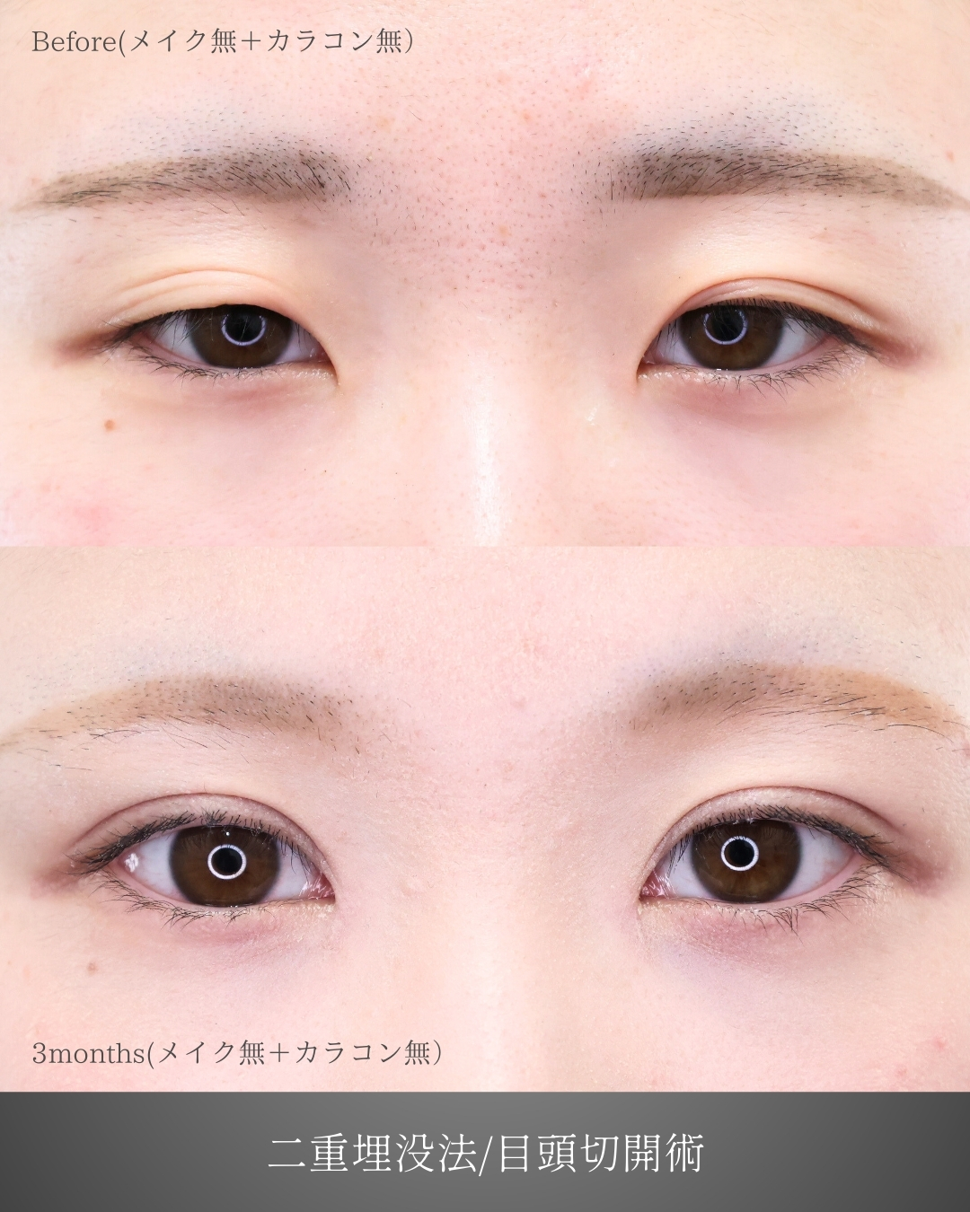 二重埋没法/目頭切開術の症例写真 施術前後 