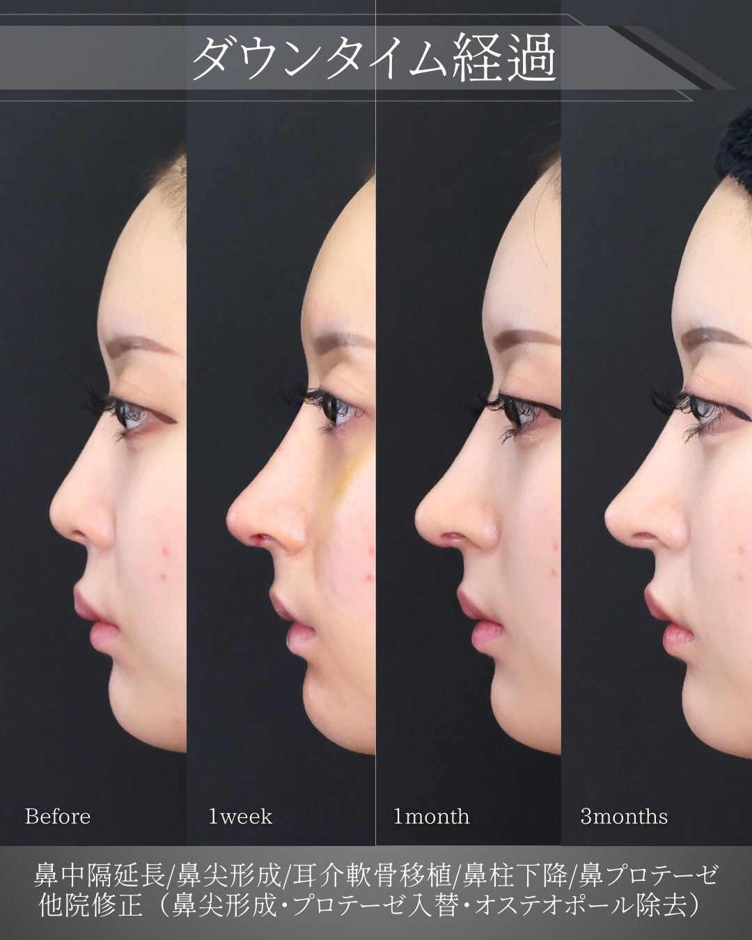鼻中隔延長術/鼻尖形成・鼻尖縮小/鼻先軟骨移植の症例写真 施術前後 