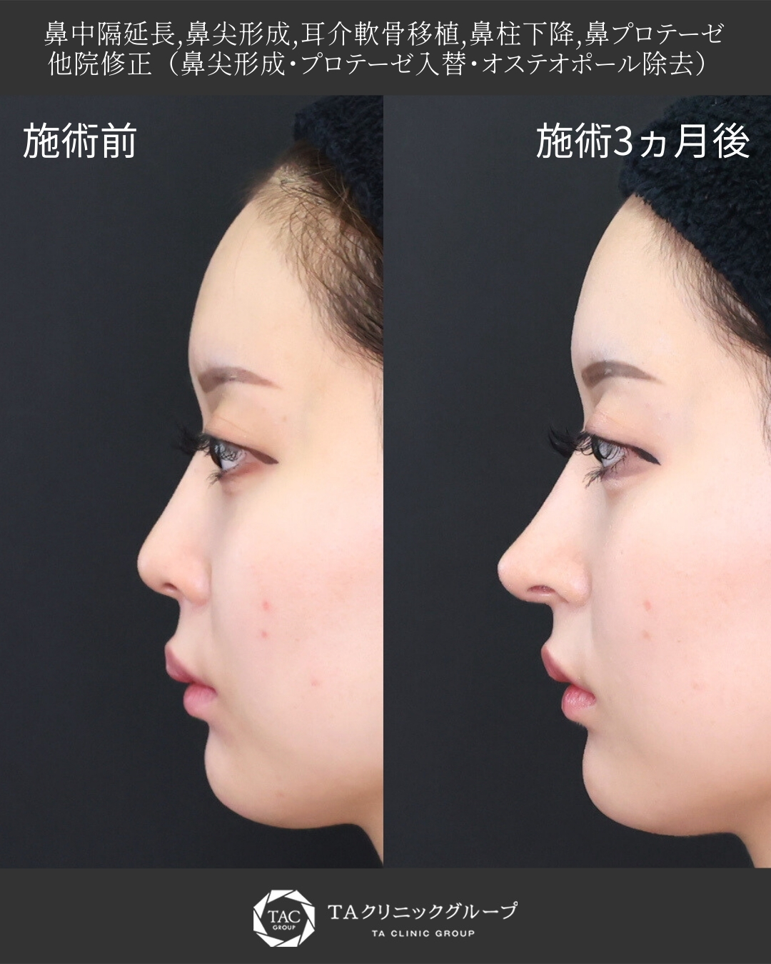 【鼻フル整形】丸く上向きの鼻→五角形のちゅん鼻に