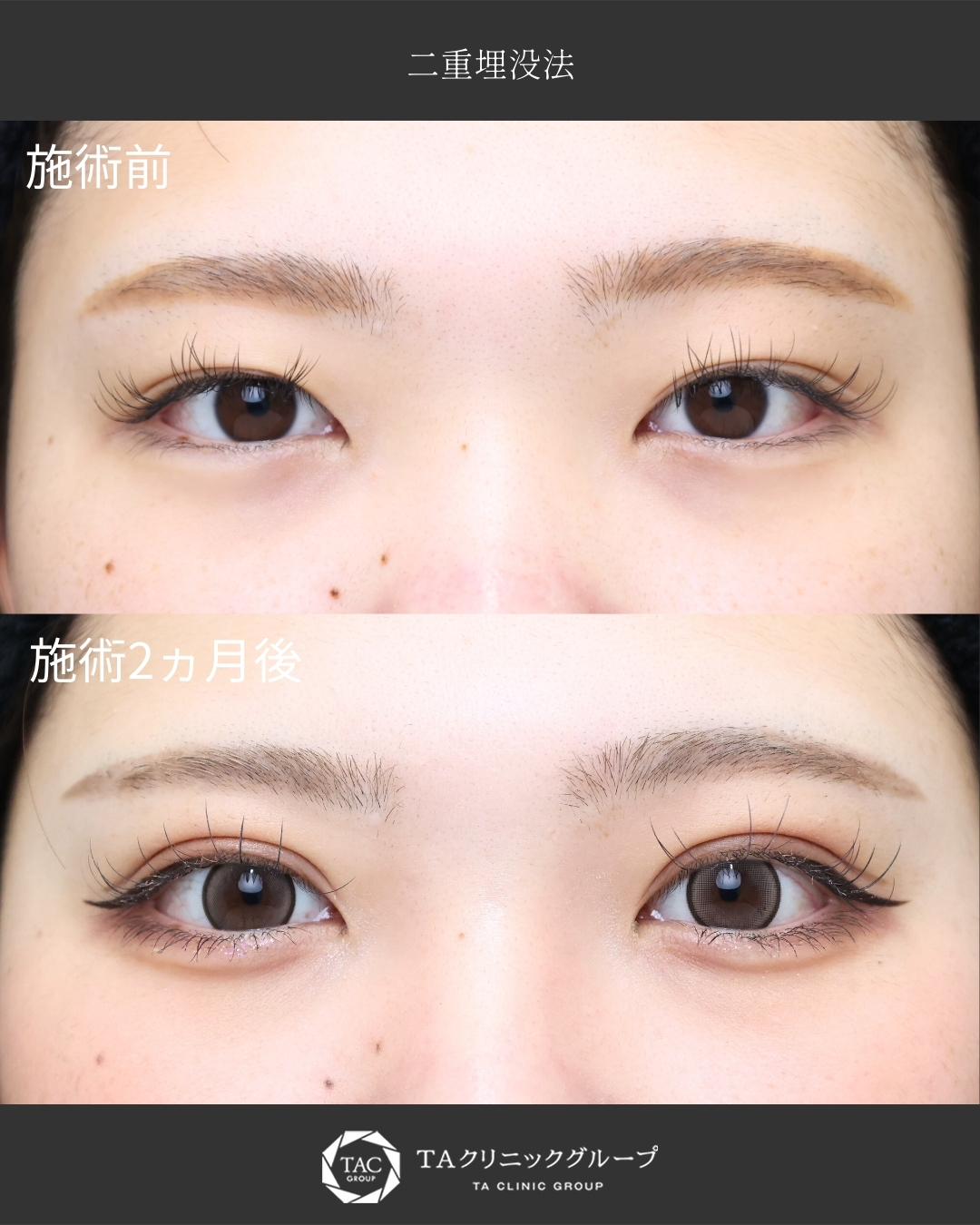 【二重埋没法】アイプチ卒業＋まつエクが映える目元に！