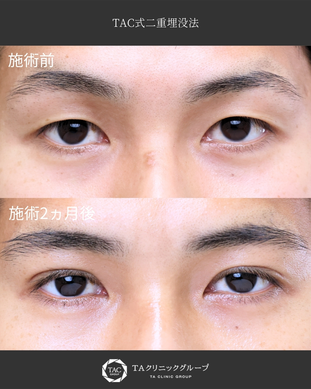 【メンズ二重埋没】長年お悩みだった一重を二重に！