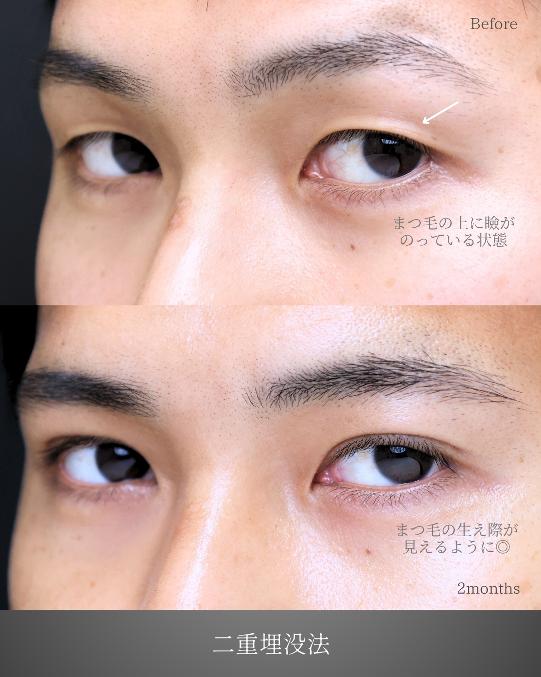 二重埋没法の症例写真 施術前後 