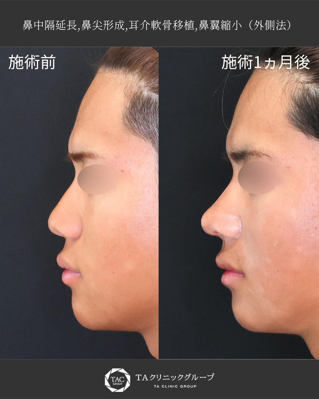 【メンズ鼻整形】鼻を整えて顔全体の印象も整える◎