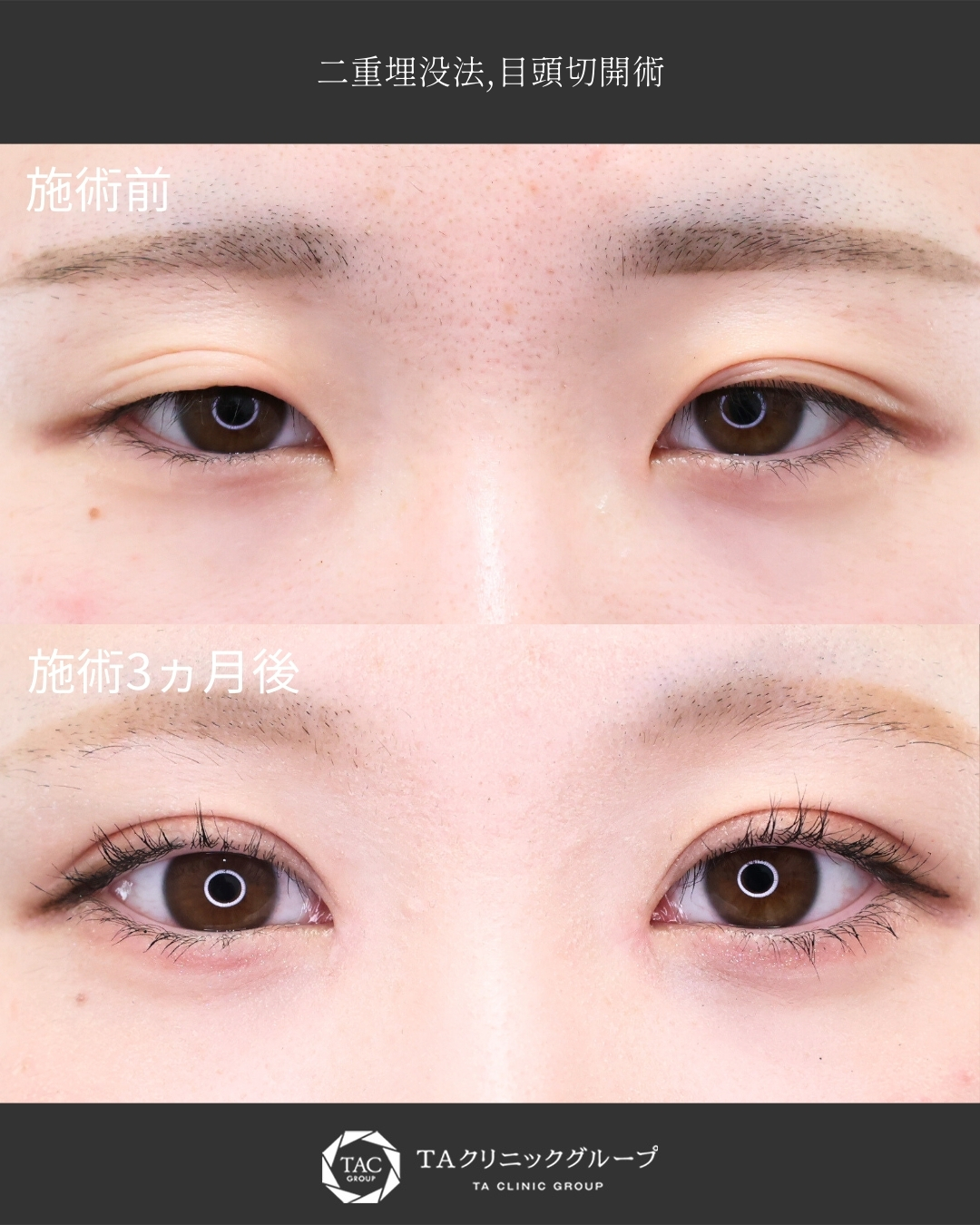 【二重埋没×目頭切開】たるんだ瞼と蒙古襞を改善◎