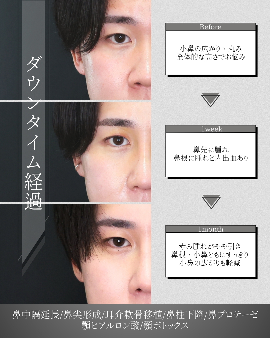 鼻中隔延長術/鼻尖形成・鼻尖縮小/隆鼻術（プロテーゼ・自家組織）の症例写真 施術前後 