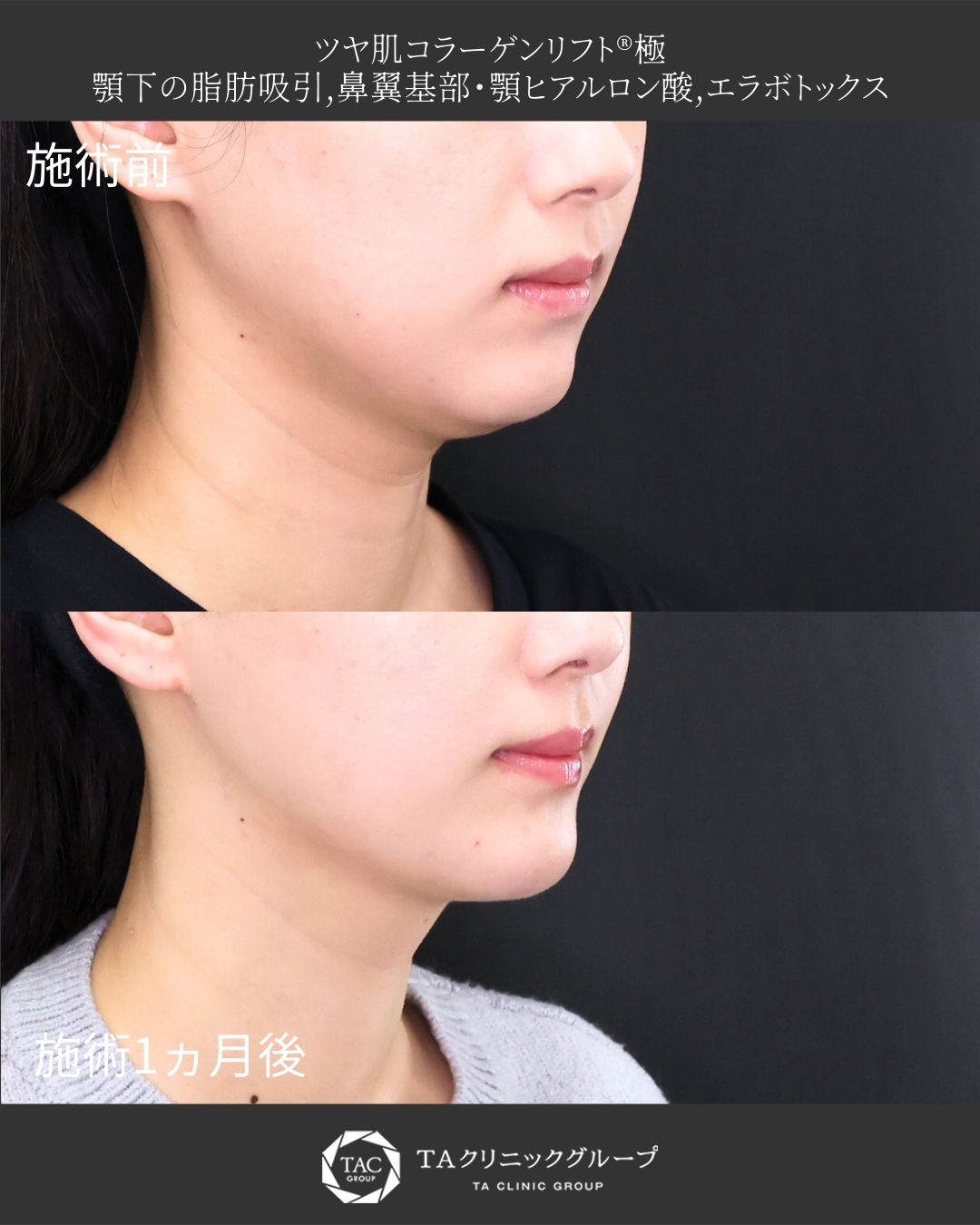 【顎下の脂肪吸引】たるんだ印象を与える二重顎卒業！