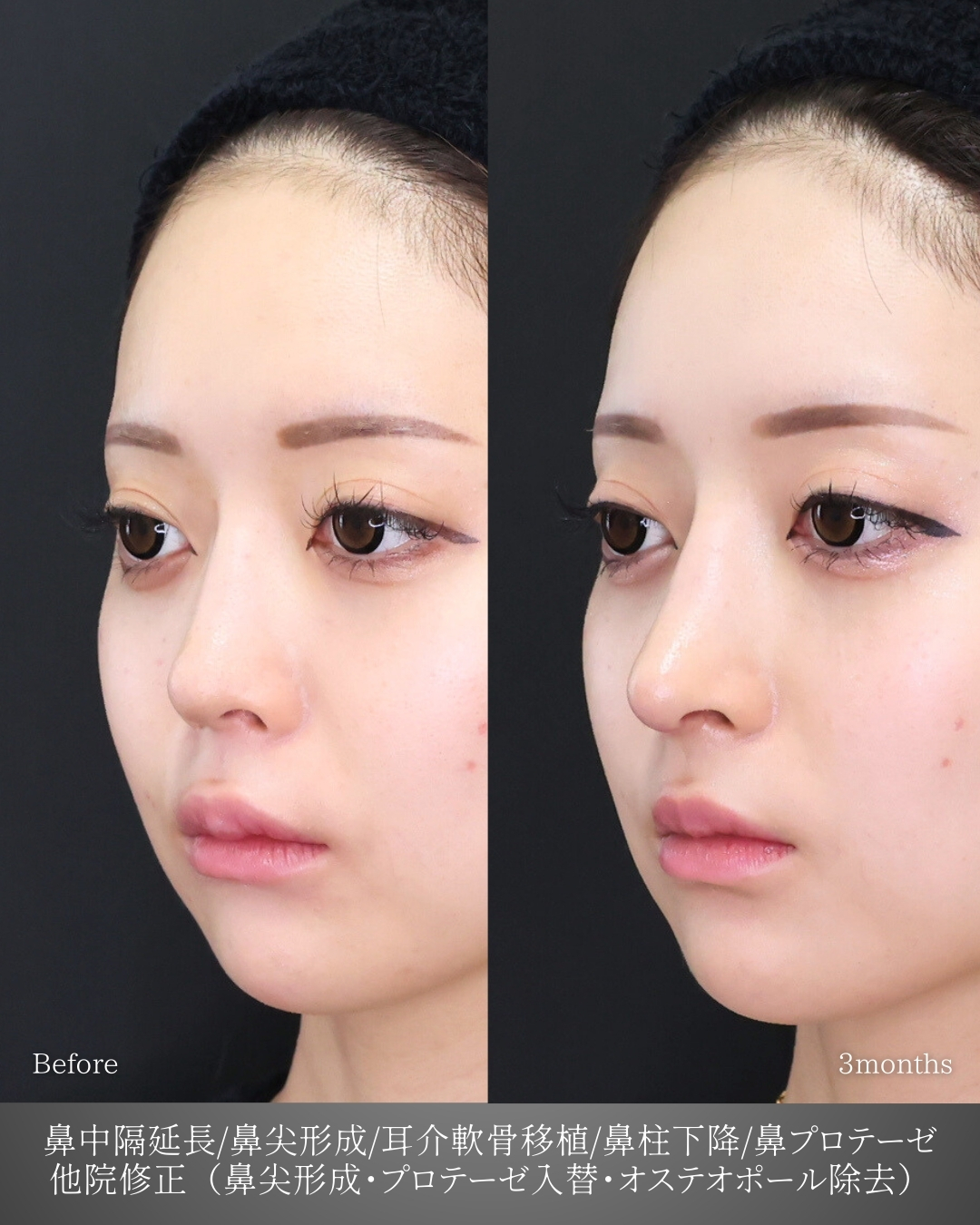 鼻中隔延長術/鼻尖形成・鼻尖縮小/鼻先軟骨移植の症例写真 施術前後 