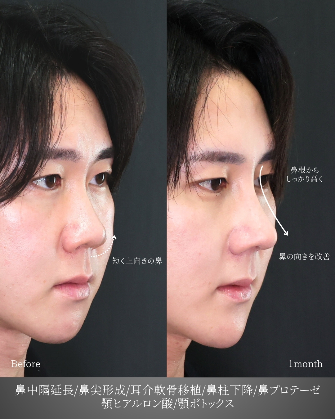 鼻中隔延長術/鼻尖形成・鼻尖縮小/隆鼻術（プロテーゼ・自家組織）の症例写真 施術前後 