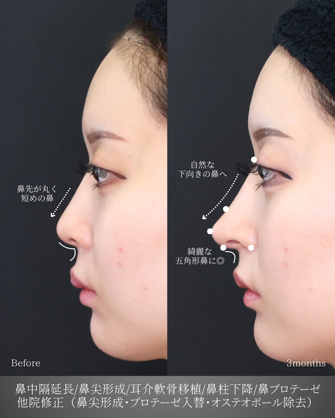 鼻中隔延長術/鼻尖形成・鼻尖縮小/鼻先軟骨移植の症例写真 施術前後 