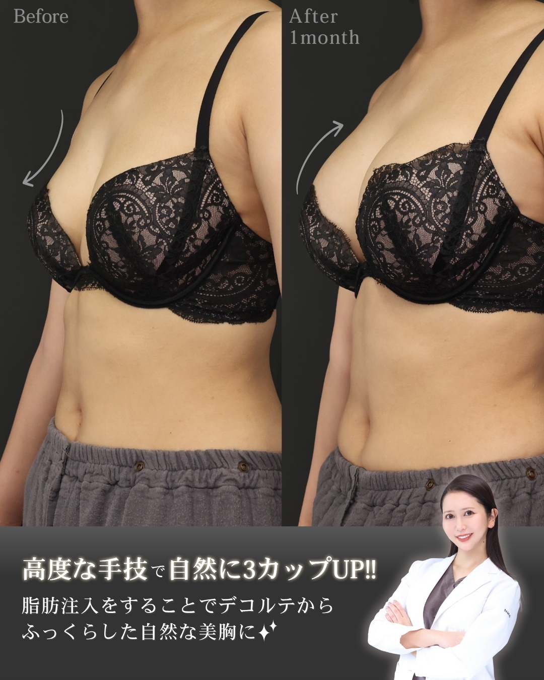 豊胸・バスト：その他/シリコンバッグ豊胸（人工乳腺バッグ）/脂肪注入豊胸（コンデンスリッチ・ピュアグラフト・１day脂肪豊胸）の症例写真 施術前後 
