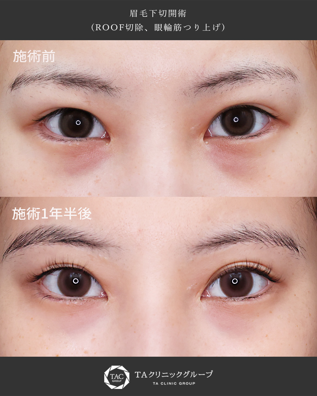 【眉下切開】ビフォーアフター❘まぶたの重さにご注目下さい