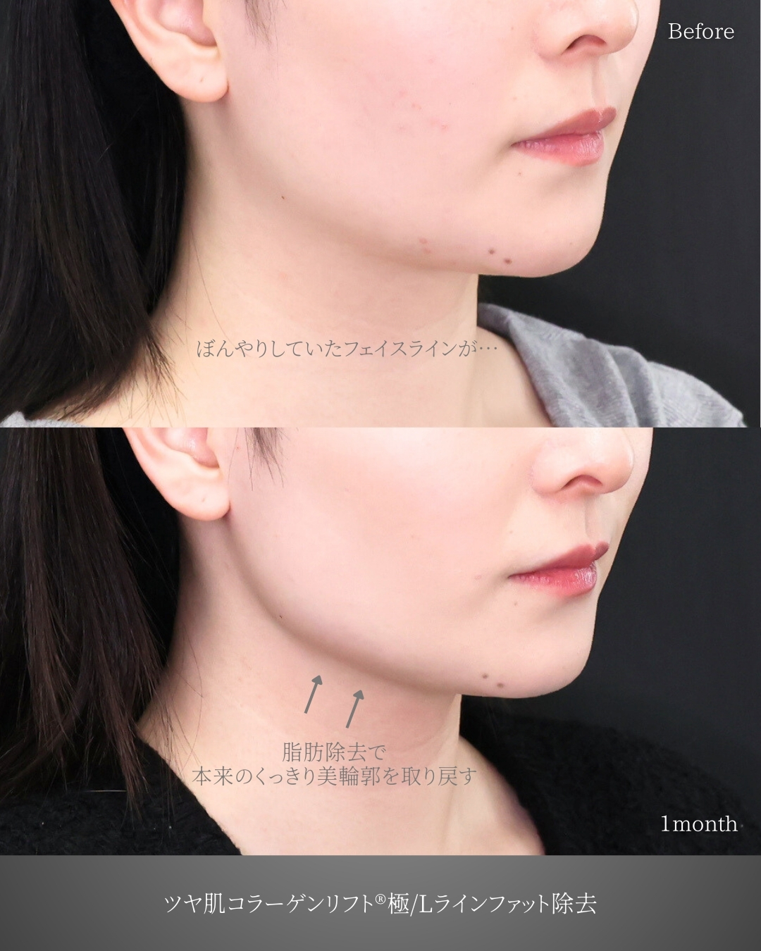 TAC式 ツヤ肌コラーゲンリフト®/Lラインファット除去（エラ下脂肪除去）の症例写真 施術前後 