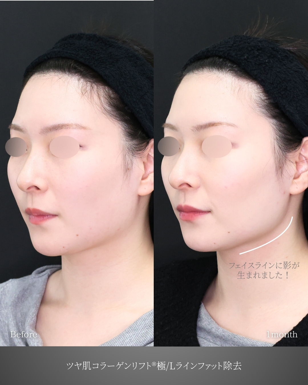 TAC式 ツヤ肌コラーゲンリフト®/Lラインファット除去（エラ下脂肪除去）の症例写真 施術前後 