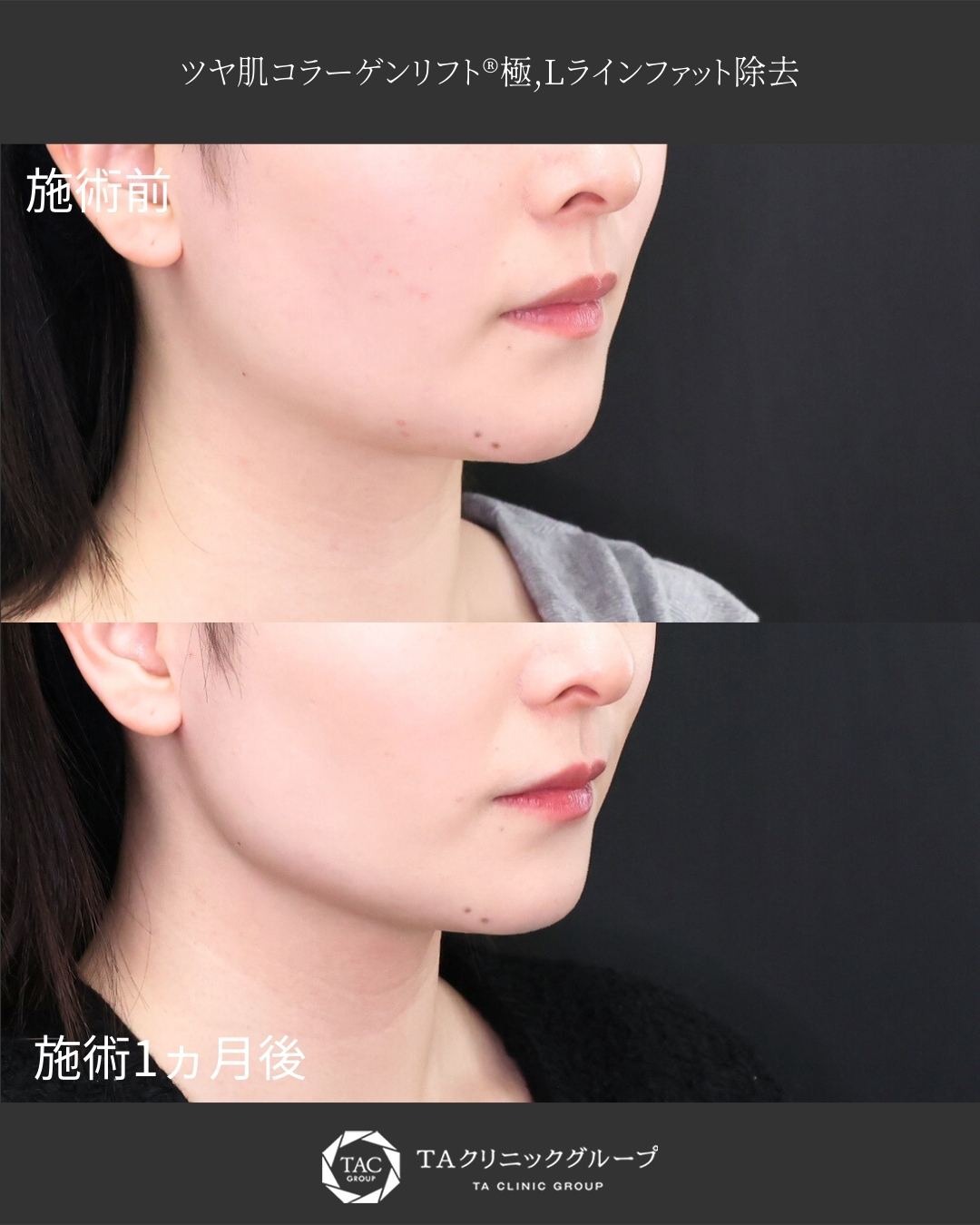 【脂肪吸引】エラ周りの余分な脂肪除去でくっきりフェイスラインへ！