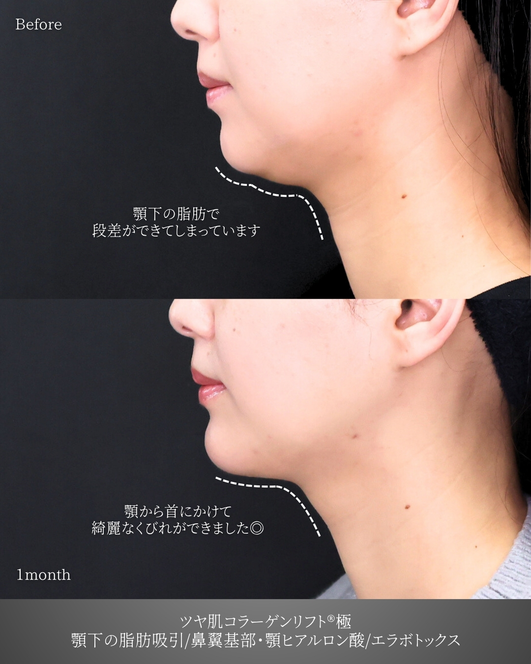 TAC式 ツヤ肌コラーゲンリフト®/顔の脂肪吸引/顎のヒアルロン酸注射の症例写真 施術前後 