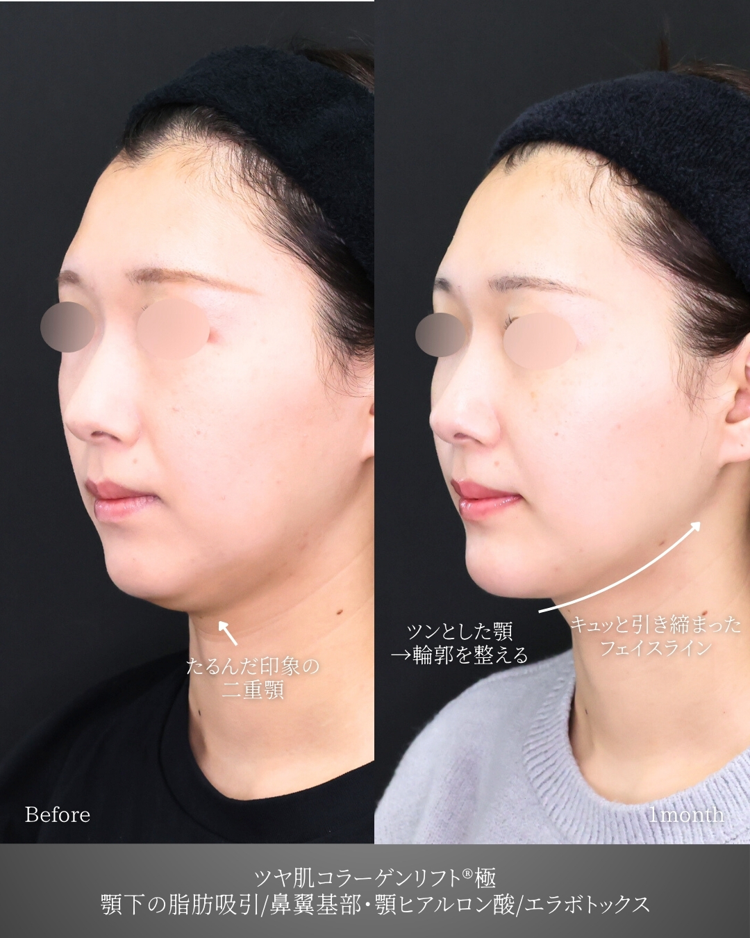TAC式 ツヤ肌コラーゲンリフト®/顔の脂肪吸引/顎のヒアルロン酸注射の症例写真 施術前後 