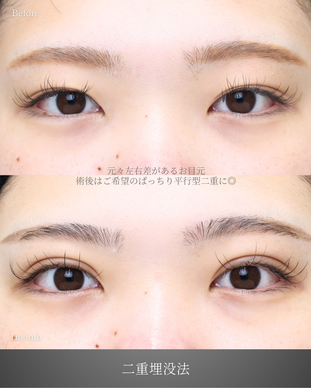 二重埋没法の症例写真 施術前後 