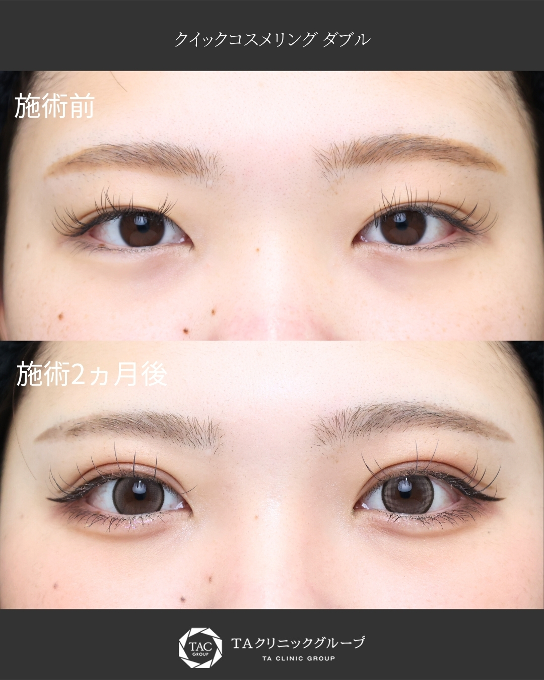 【二重埋没法】アイプチ卒業＋まつエクが映える目元に！