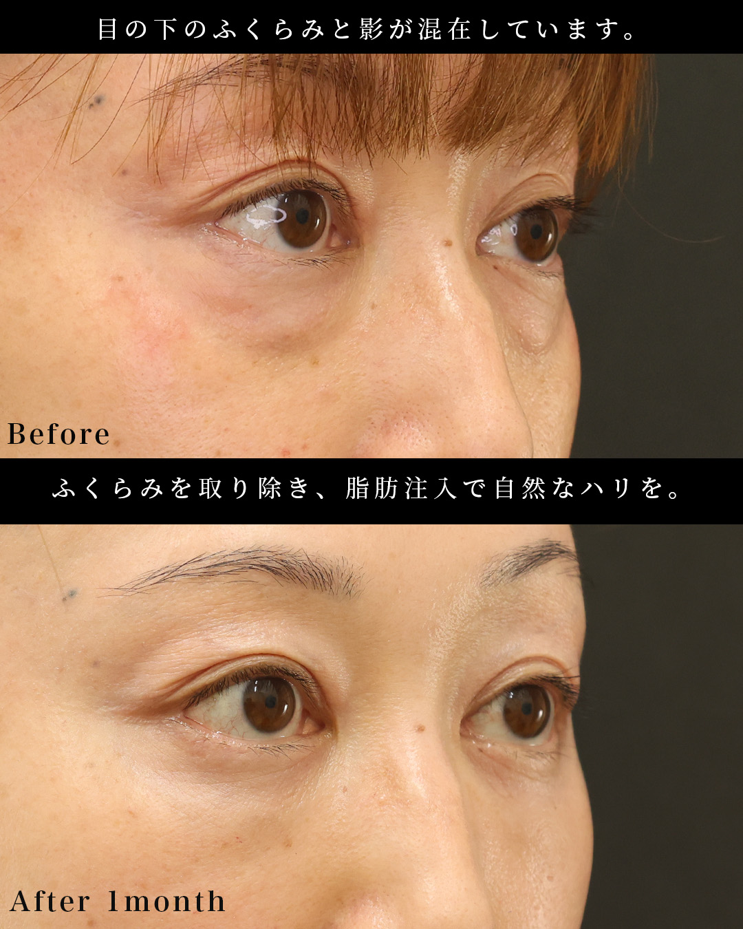 下眼瞼脱脂術（目の下のたるみ取り・目の下の脂肪ふくらみ取り）/顔の脂肪注入(コンデンスリッチフェイス)の症例写真 施術前後 