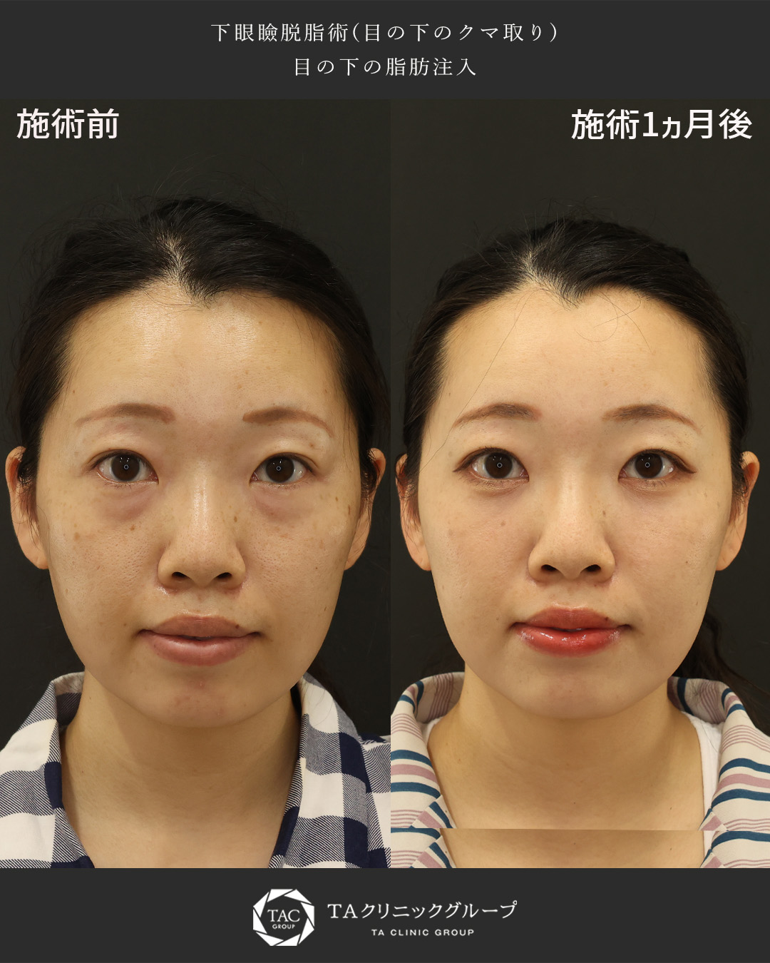 疲れた印象を改善し自然に若返り【クマ取り＋目の下の脂肪注入】