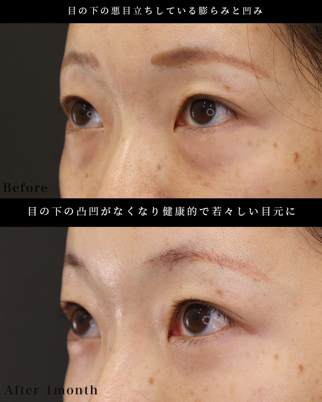 下眼瞼脱脂術（目の下のたるみ取り・目の下の脂肪ふくらみ取り）/顔の脂肪注入(コンデンスリッチフェイス)の症例写真 施術前後 