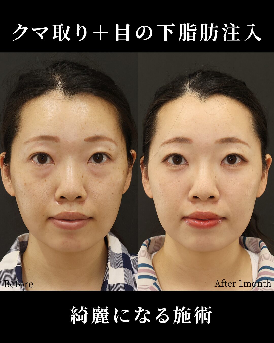 下眼瞼脱脂術（目の下のたるみ取り・目の下の脂肪ふくらみ取り）/顔の脂肪注入(コンデンスリッチフェイス)の症例写真 施術前後 1ヵ月