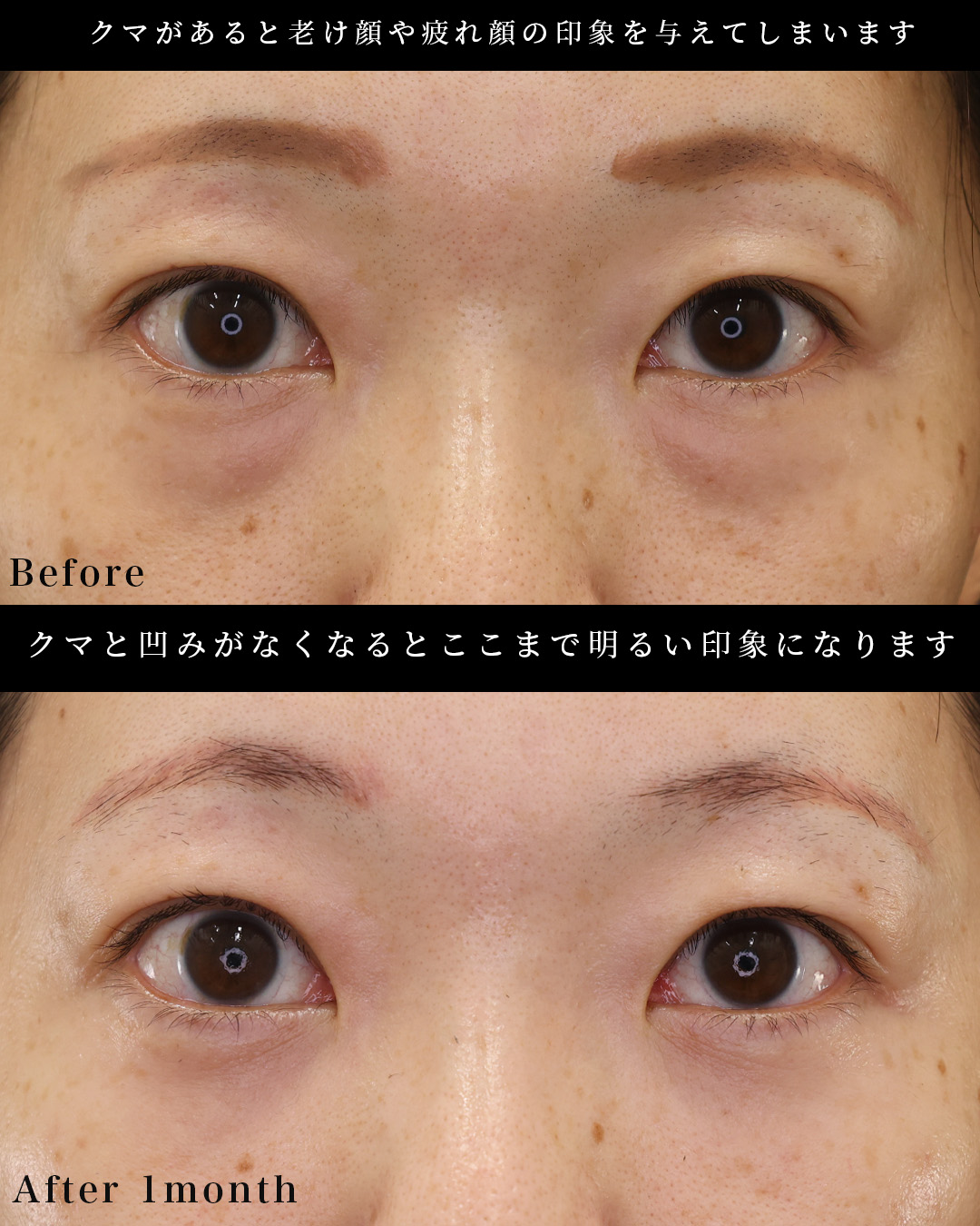 下眼瞼脱脂術（目の下のたるみ取り・目の下の脂肪ふくらみ取り）/顔の脂肪注入(コンデンスリッチフェイス)の症例写真 施術前後 