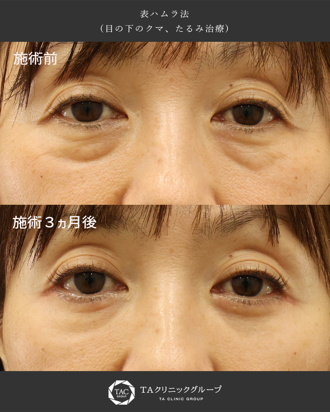 確実に変化し魅力度UP！【表ハムラ法】