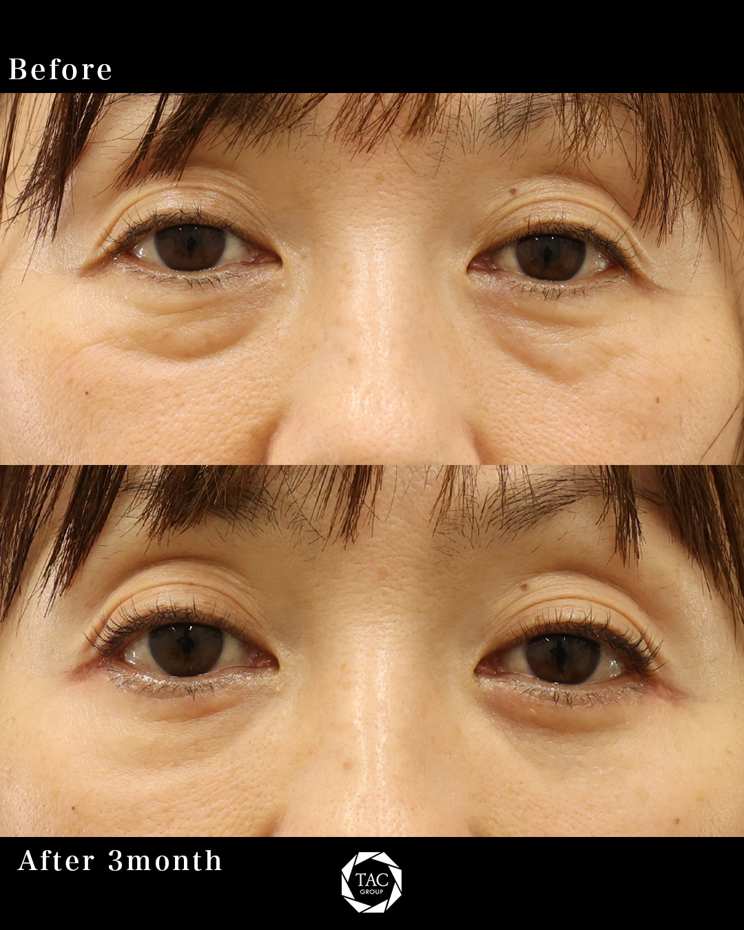 確実に変化し魅力度UP！【表ハムラ法】