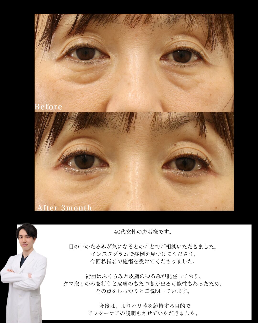 下眼瞼切開術（クマ・たるみとり）の症例写真 施術前後 