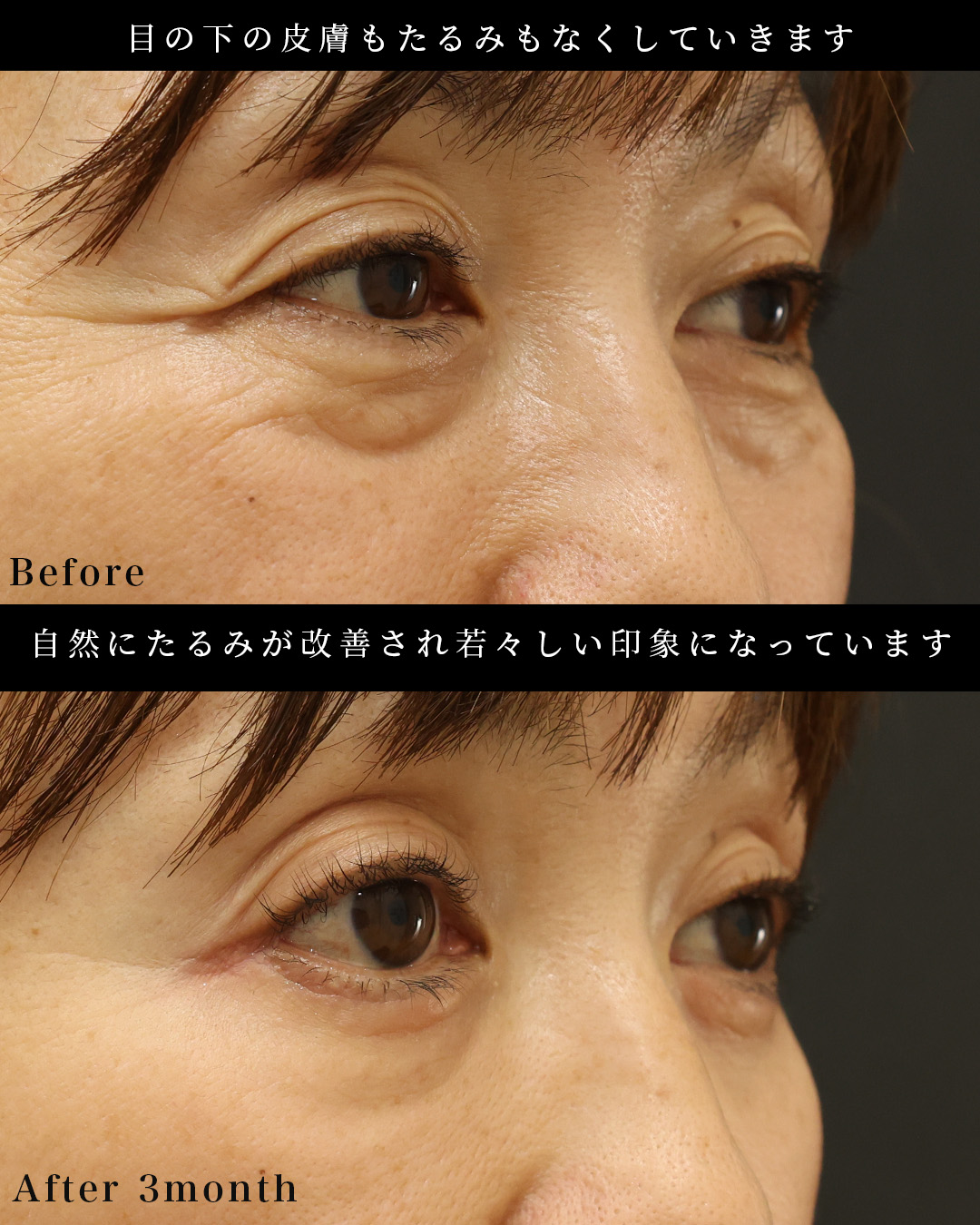 下眼瞼切開術（クマ・たるみとり）の症例写真 施術前後 