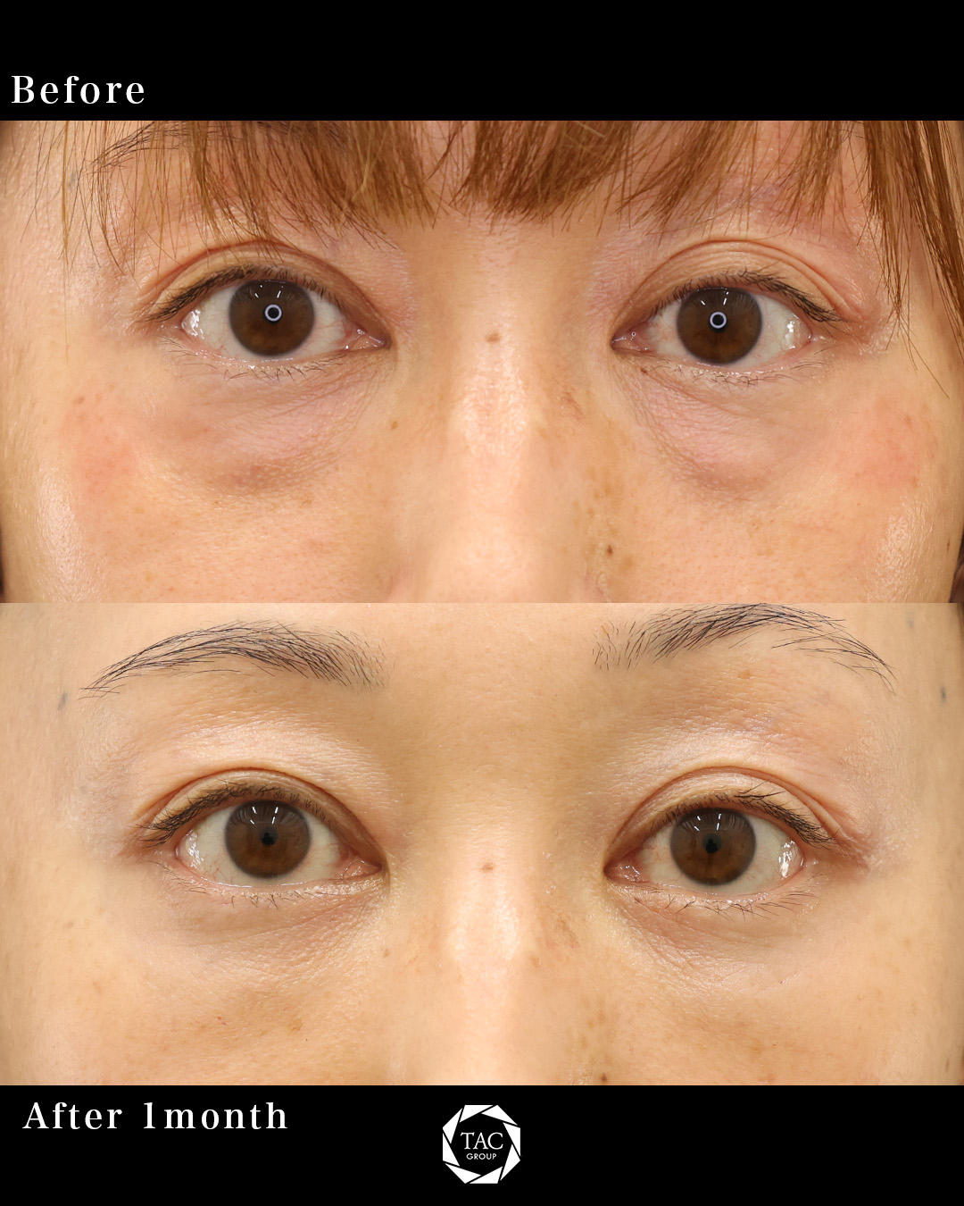 アイメイクが楽しくなる【クマ取り＋目の下の脂肪注入】