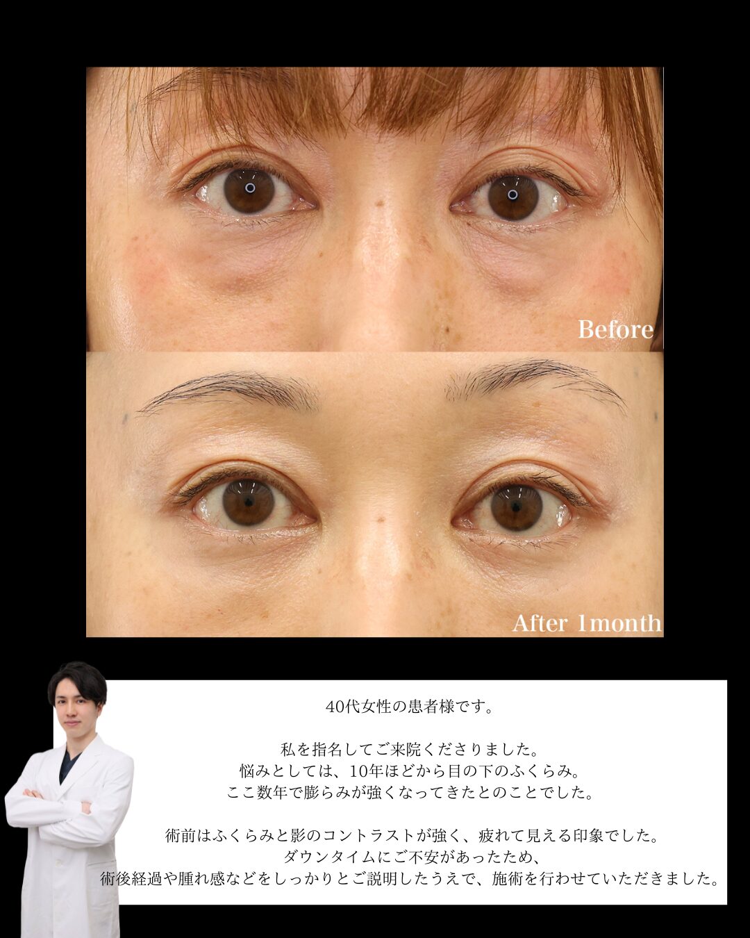 下眼瞼脱脂術（目の下のたるみ取り・目の下の脂肪ふくらみ取り）/顔の脂肪注入(コンデンスリッチフェイス)の症例写真 施術前後 