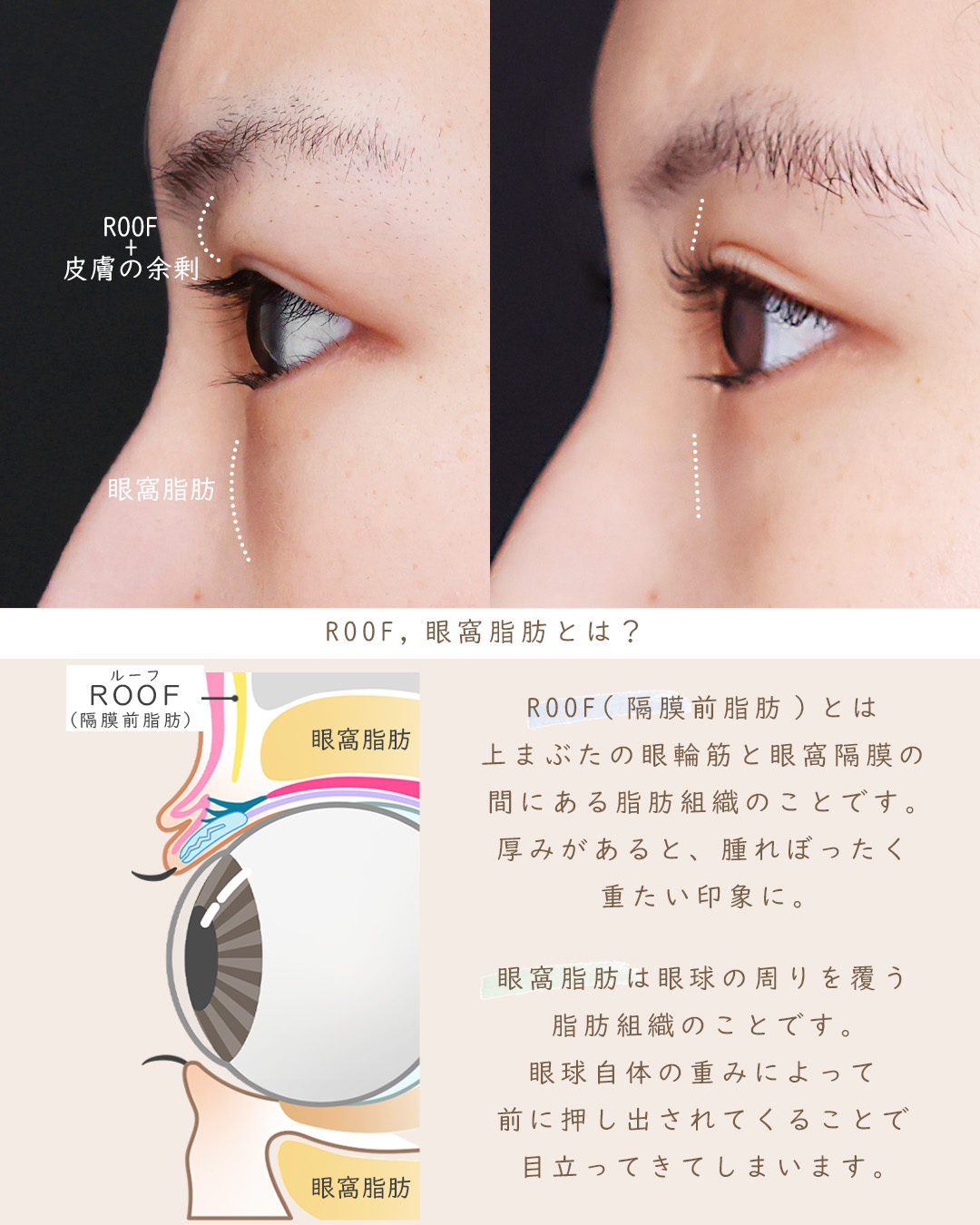 眉毛下切開術の症例写真 施術前後 