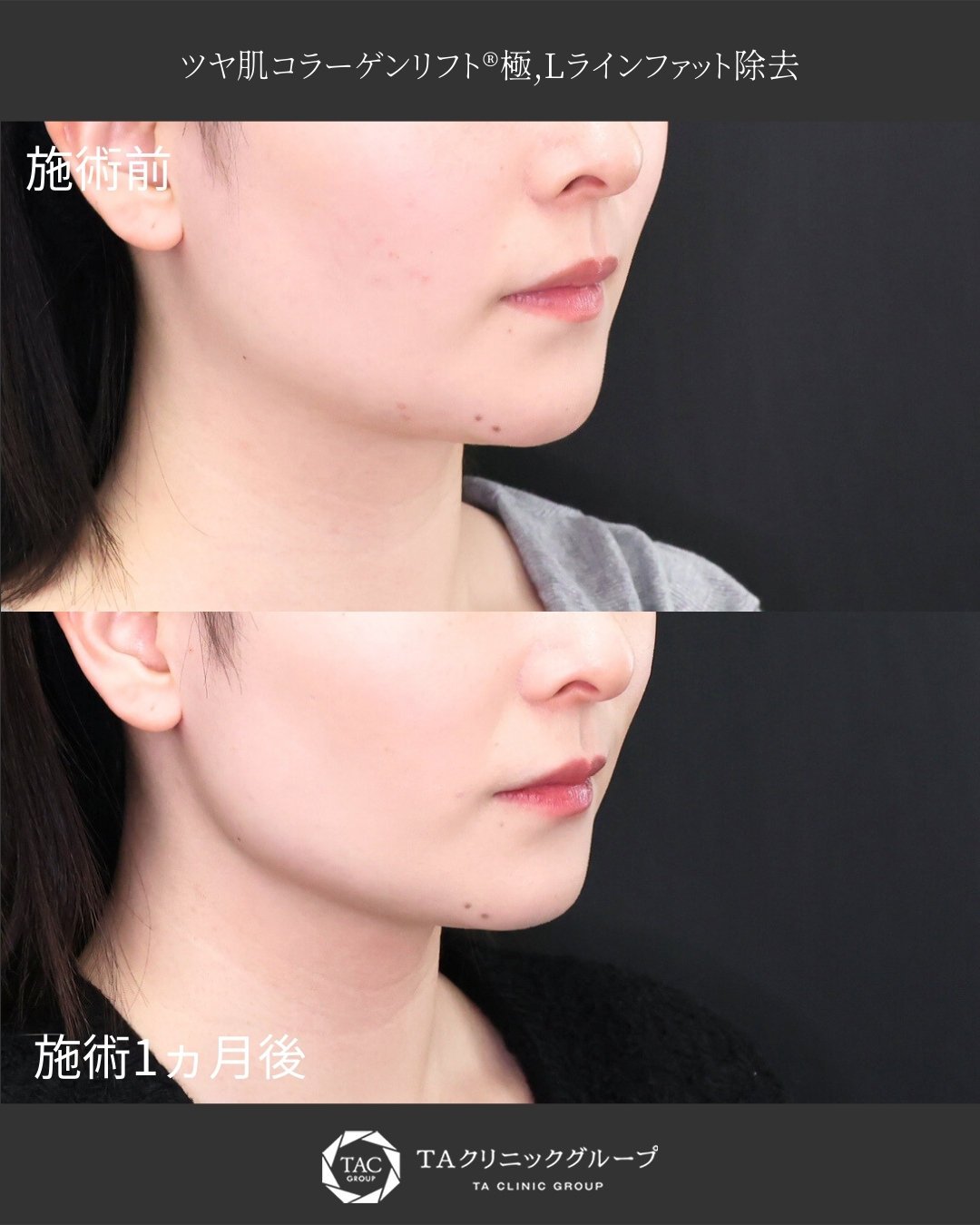 【脂肪吸引】エラ周りの余分な脂肪除去でくっきりフェイスラインへ！