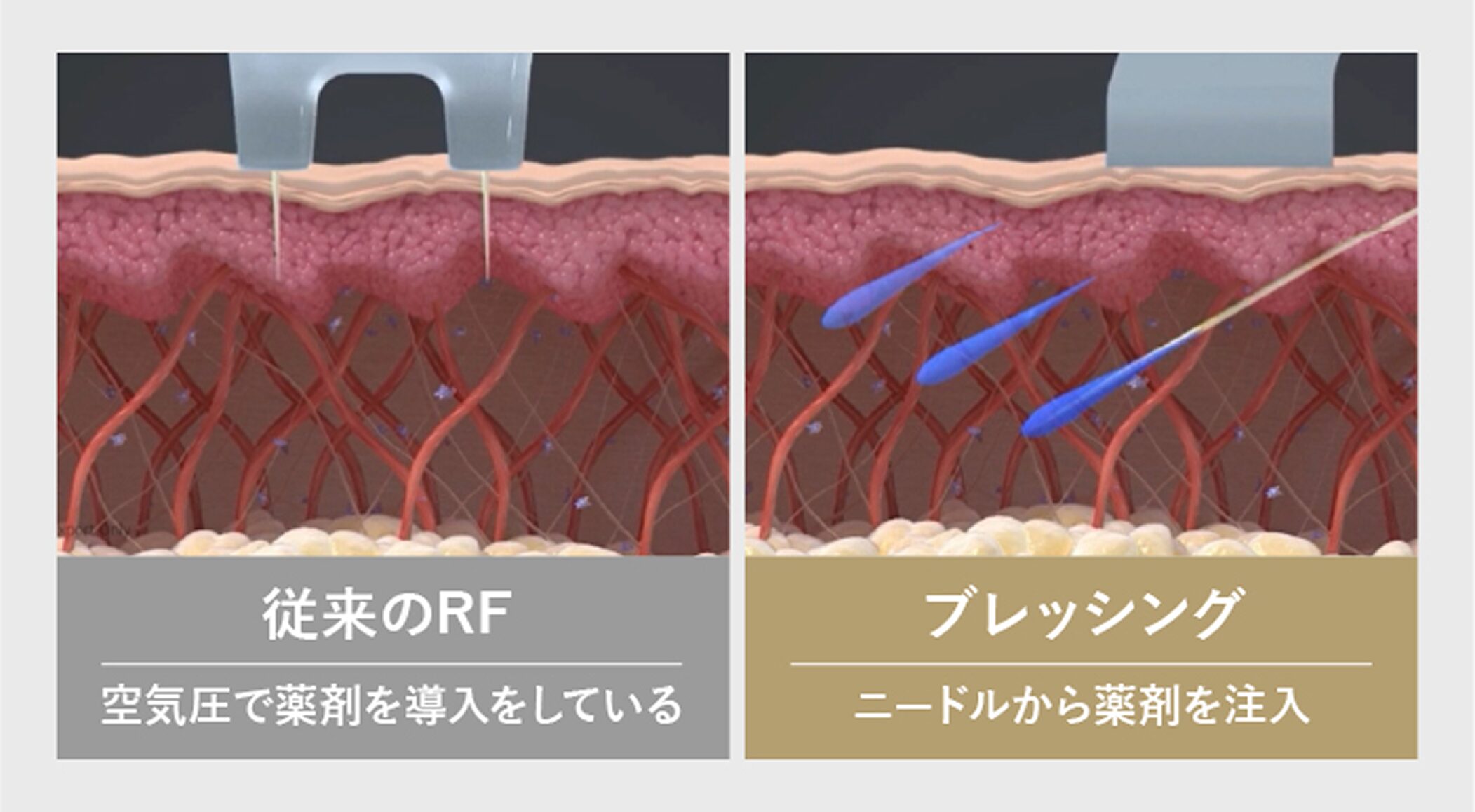 ブレッシングのインジェクションモード