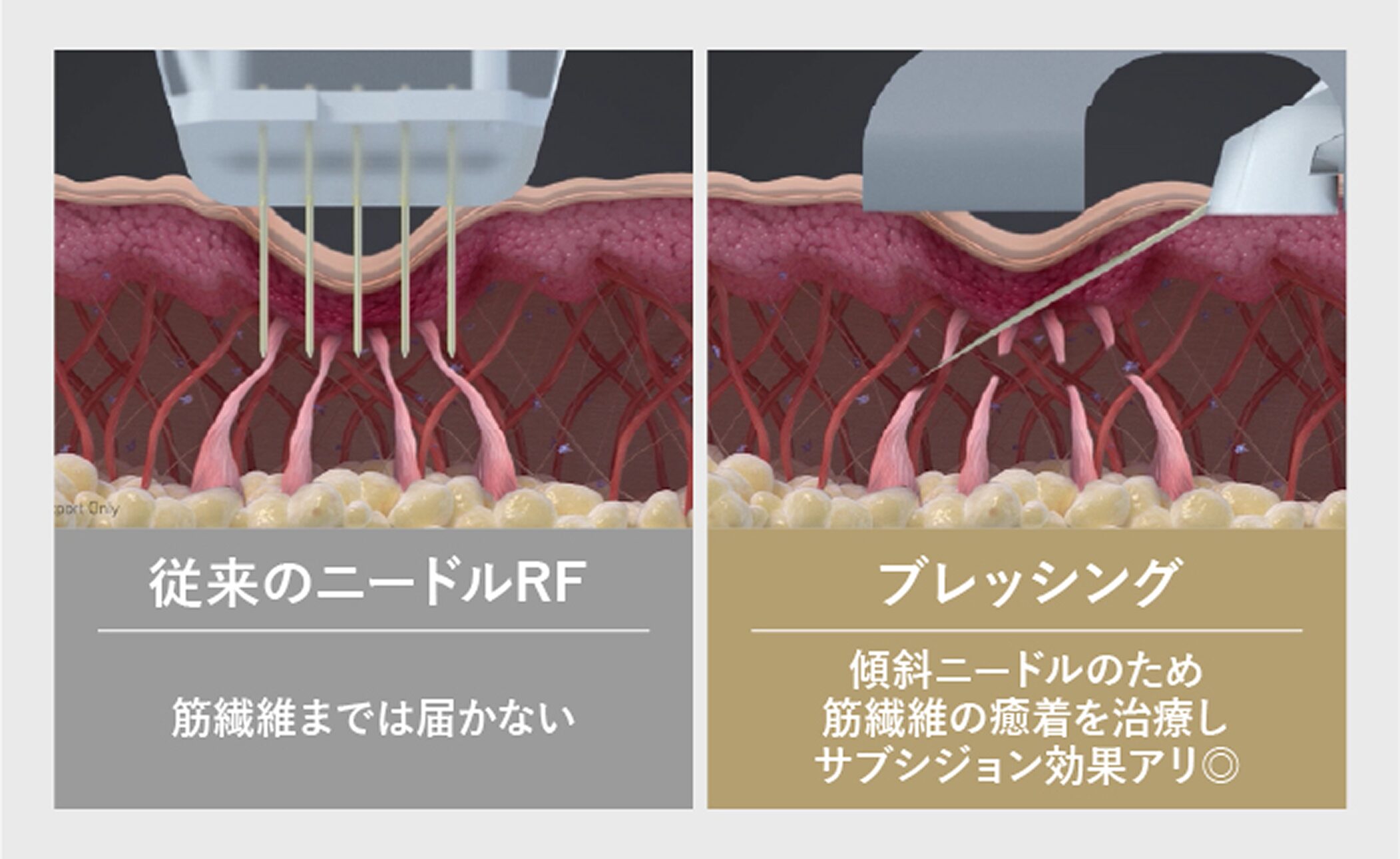 ブレッシングのサブシジョン効果