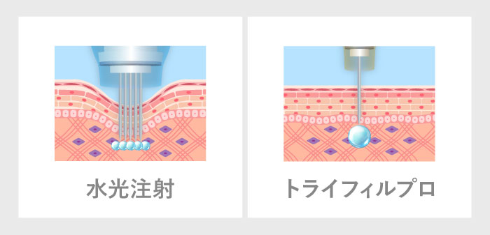 その他ニードル投入機器との違い