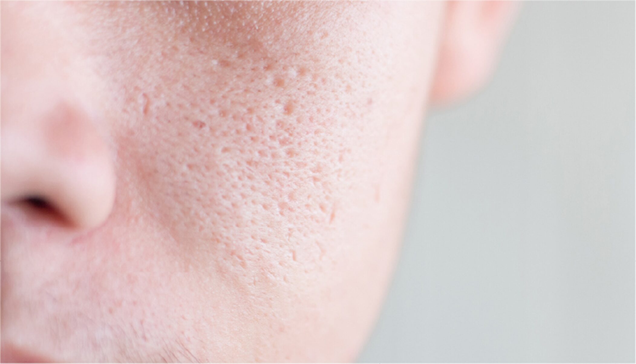 ニキビ跡・クレーター改善