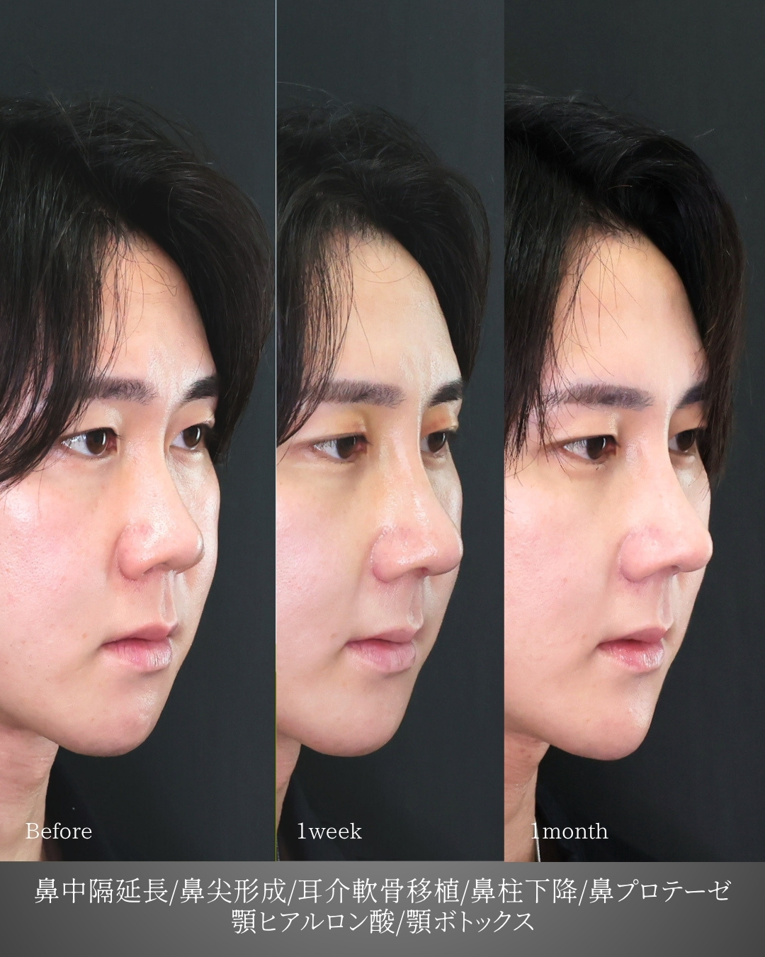 鼻中隔延長術/鼻尖形成・鼻尖縮小/隆鼻術（プロテーゼ・自家組織）の症例写真 施術前後 
