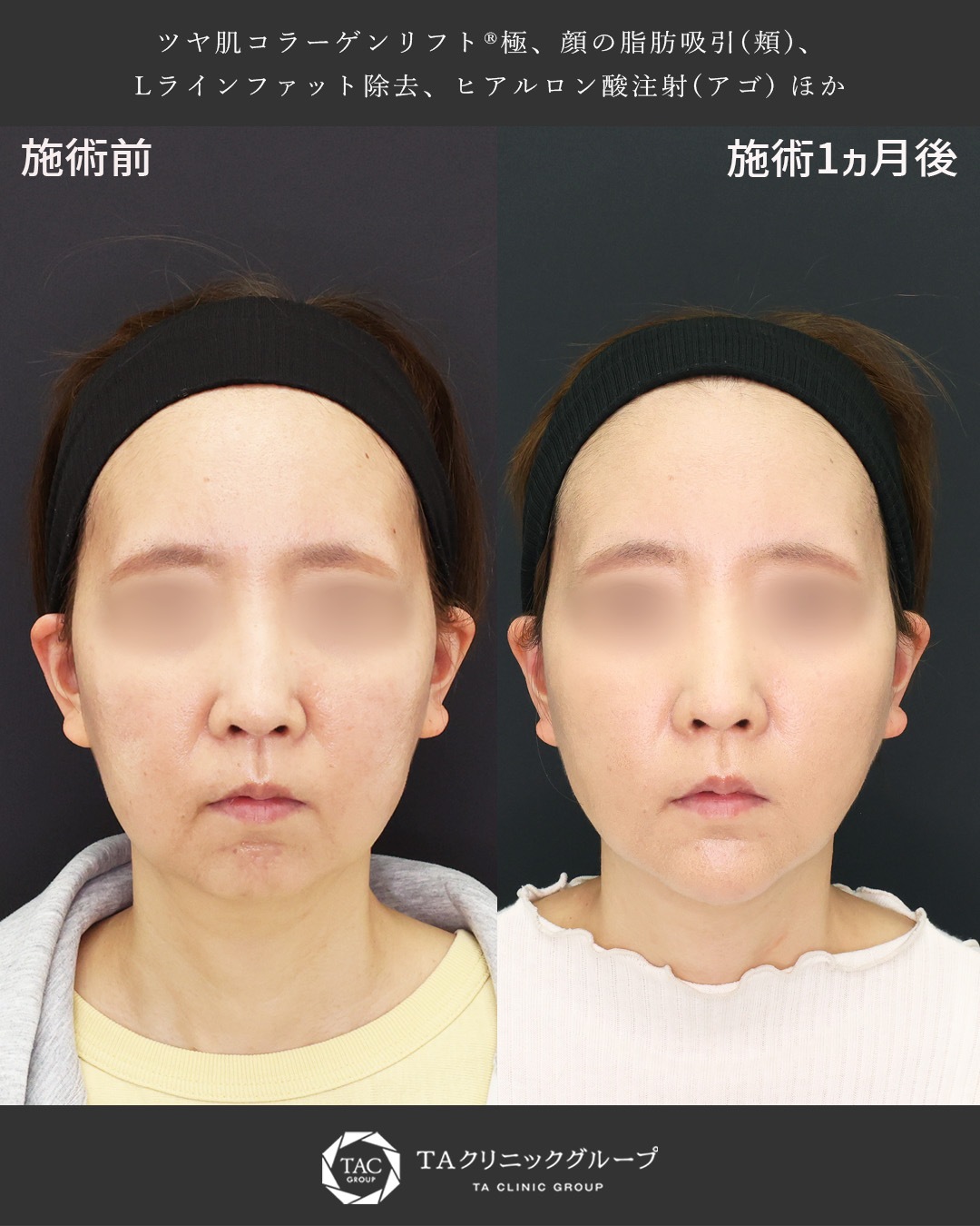 【40代】お顔のもたつき×マリオネットラインのお悩み解消