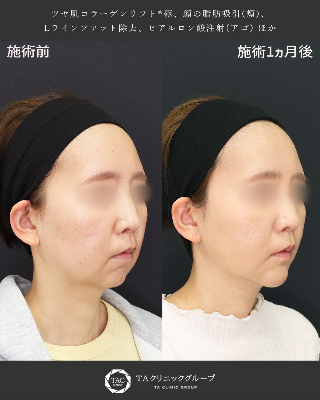 TAC式 ツヤ肌コラーゲンリフト®/顔の脂肪吸引/Lラインファット除去（エラ下脂肪除去）の症例写真 施術前後 