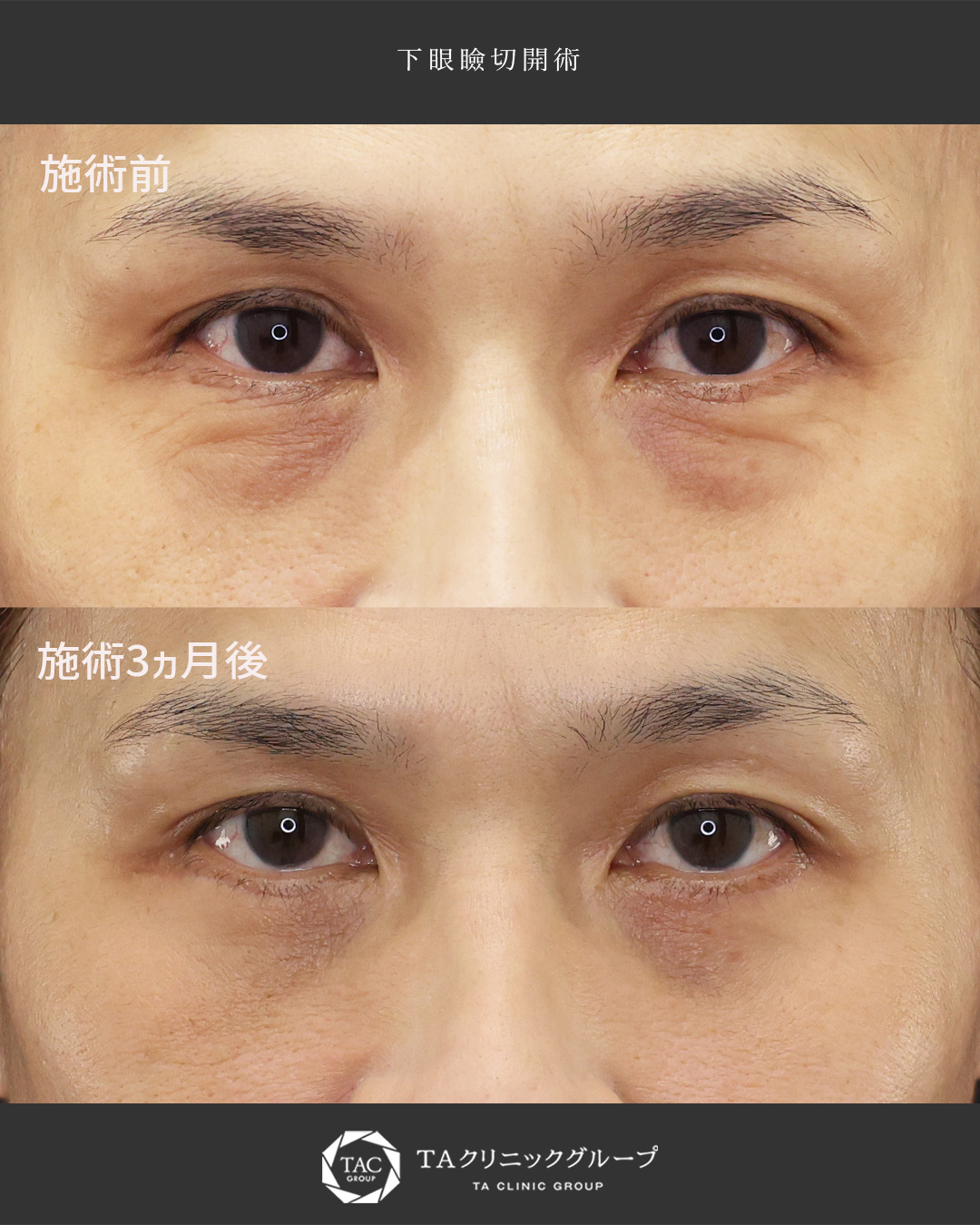 【50代】目の下のたるみ取りで、スッキリとしたお目元に。