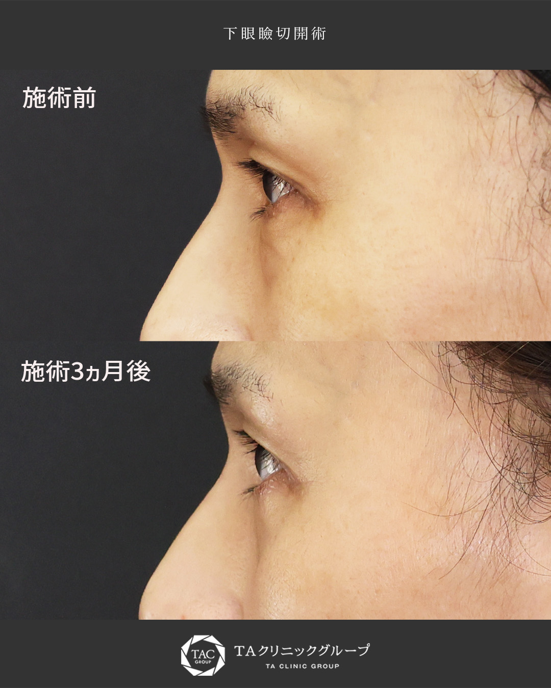 下眼瞼切開術（クマ・たるみとり）の症例写真 施術前後 