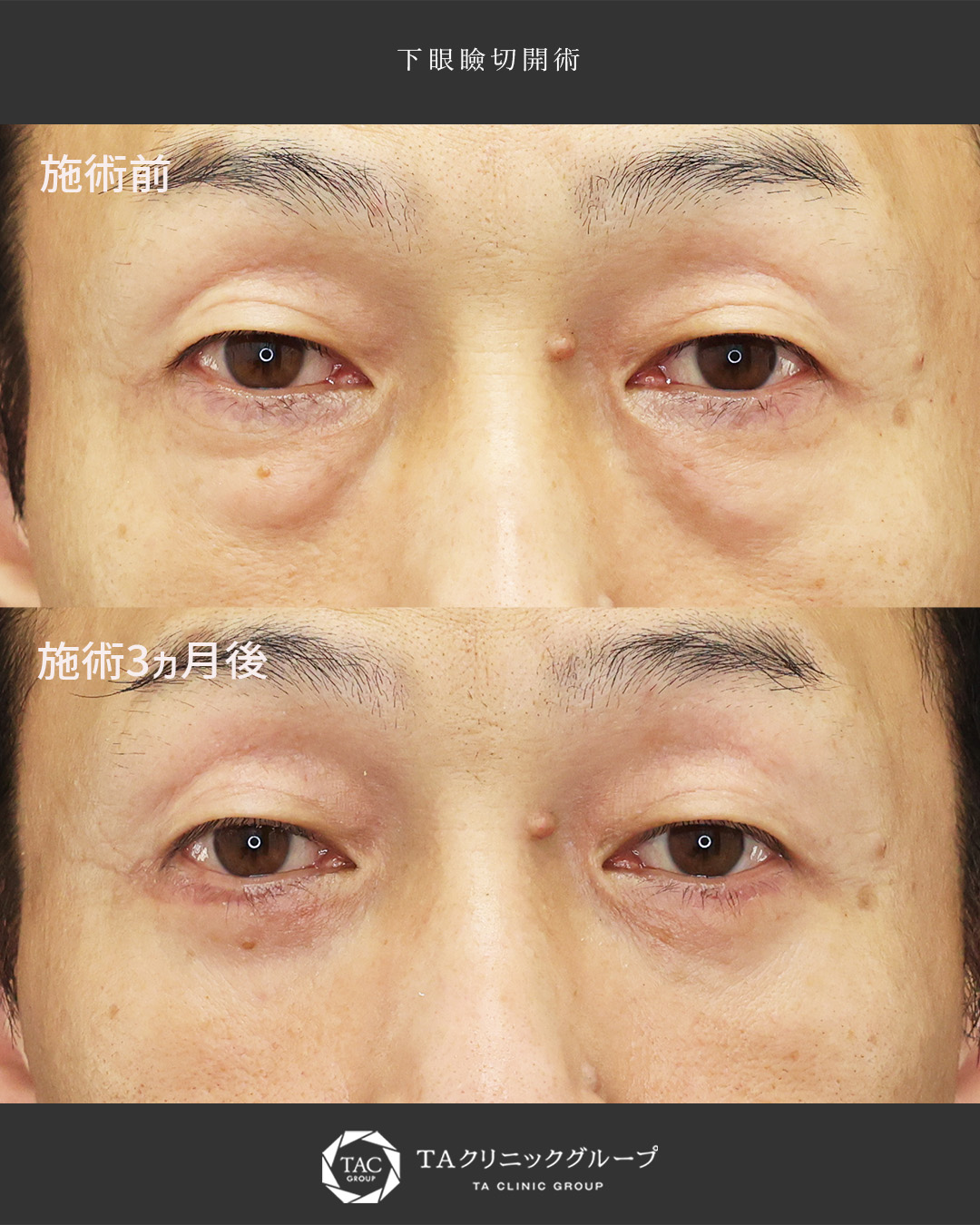 【50代】気になる目の下のたるみを解消